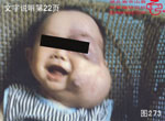 血管瘤病理图片图261-图280(图12)