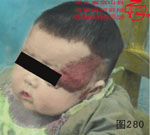 血管瘤病理图片图261-图280(图19)