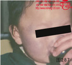 血管瘤病理图片图281-图300(图6)