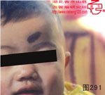 血管瘤病理图片图281-图300(图10)