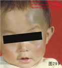 血管瘤病理图片图281-图300(图18)