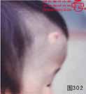 血管瘤病理图片图301-图320(图2)