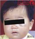 血管瘤病理图片图301-图320(图5)