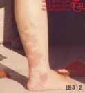 血管瘤病理图片图301-图320(图12)