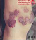 血管瘤病理图片图321-图340(图2)
