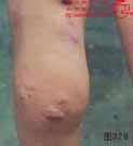 血管瘤病理图片图321-图340(图5)