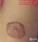 血管瘤病理图片图321-图340(图12)