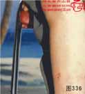 血管瘤病理图片图321-图340(图15)
