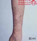 血管瘤病理图片图321-图340(图19)