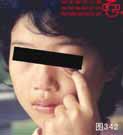 血管瘤病理图片图341-图360(图2)