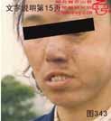 血管瘤病理图片图341-图360(图3)