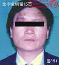 血管瘤病理图片图341-图360(图11)