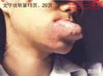 血管瘤病理图片图341-图360(图12)