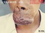 血管瘤病理图片图341-图360(图16)