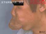 血管瘤病理图片图341-图360(图17)