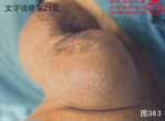 血管瘤病理图片图361-图380(图2)