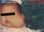 血管瘤病理图片图361-图380(图5)