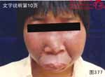 血管瘤病理图片图361-图380(图16)