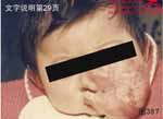 血管瘤病理图片图381-图400(图6)