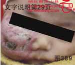 血管瘤病理图片图381-图400(图8)