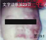 血管瘤病理图片图381-图400(图10)