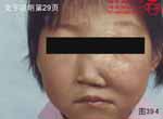 血管瘤病理图片图381-图400(图11)
