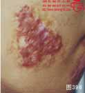 血管瘤病理图片图381-图400(图15)