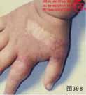 血管瘤病理图片图381-图400(图17)