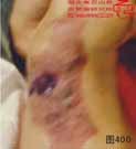 血管瘤病理图片图381-图400(图19)