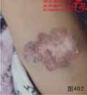 血管瘤病理图片图401-图420(图2)