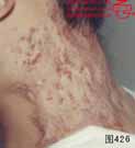 血管瘤病理图片图421-图440(图6)