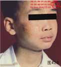血管瘤病理图片图421-图440(图8)