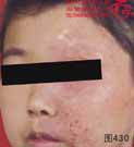 血管瘤病理图片图421-图440(图10)