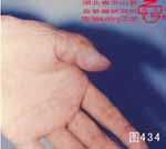 血管瘤病理图片图421-图440(图12)