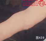 血管瘤病理图片图421-图440(图19)