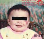 血管瘤病理图片图441-图460(图16)