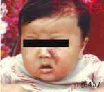 血管瘤病理图片图441-图460(图17)