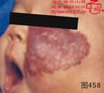 血管瘤病理图片图441-图460(图18)