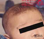 血管瘤病理图片图461-图480(图2)