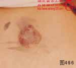 血管瘤病理图片图461-图480(图5)