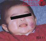 血管瘤病理图片图461-图480(图10)