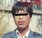 血管瘤病理图片图481-图500(图5)