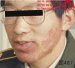 血管瘤病理图片图481-图500(图6)