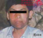 血管瘤病理图片图481-图500(图7)