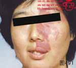 血管瘤病理图片图481-图500(图10)