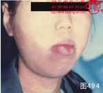 血管瘤病理图片图481-图500(图11)