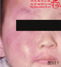 血管瘤病理图片图521-图540(图7)