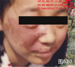 血管瘤病理图片图521-图540(图10)