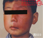 血管瘤病理图片图521-图540(图13)