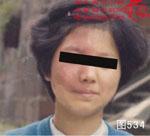 血管瘤病理图片图521-图540(图12)